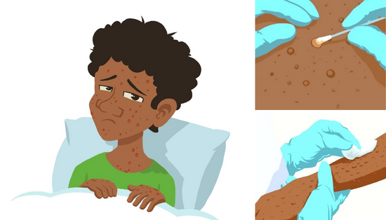 Sudan Reports First Monkeypox Case